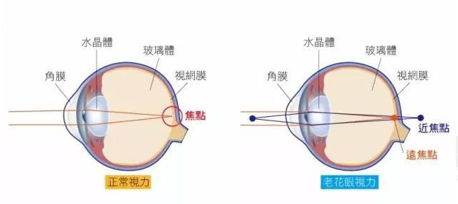 白內(nèi)障和老花眼區(qū)別，老花眼發(fā)病率正呈現(xiàn)年輕化趨勢